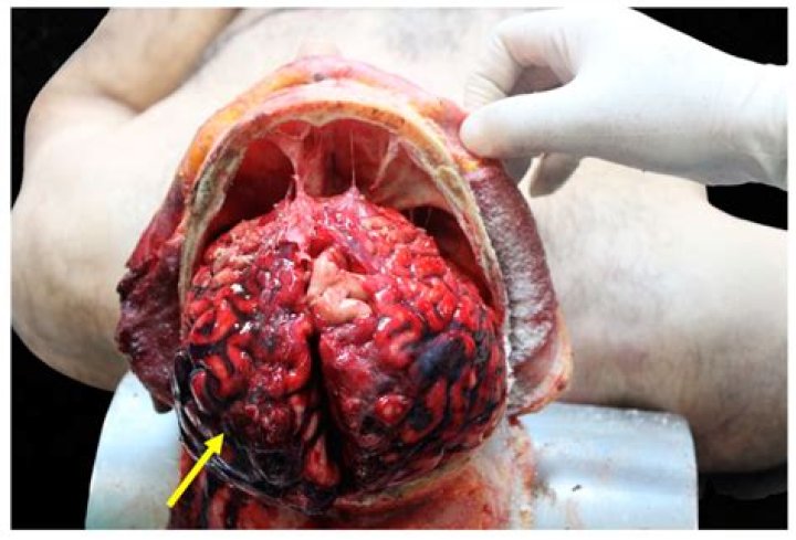 An Astonishing Look Inside Tarrare: Autopsy Findings Of A Legendary Eater
