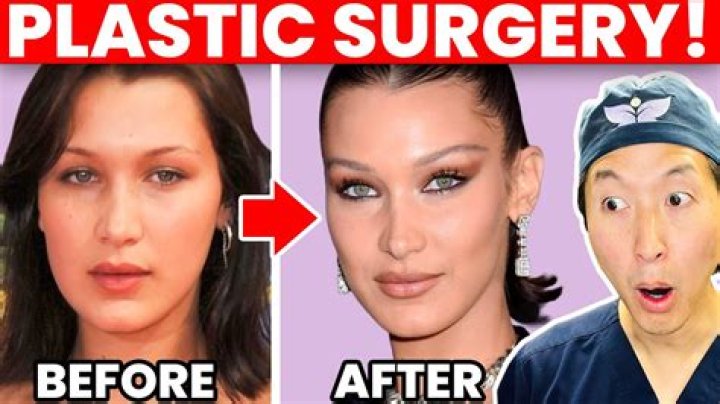 Bella Hadid's Transformation: Before And After Surgery