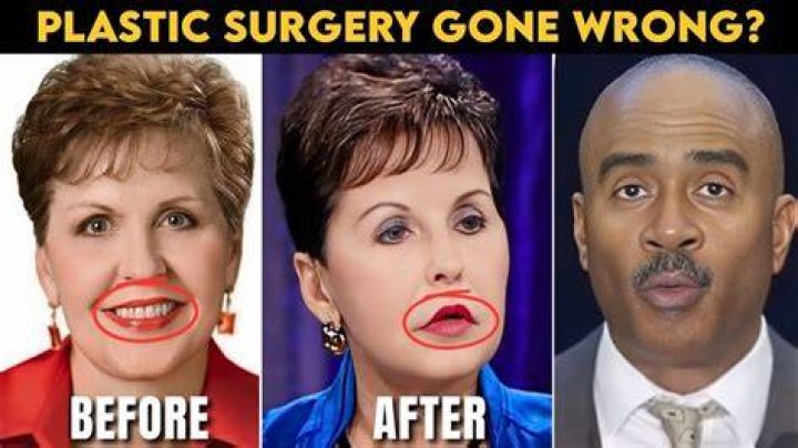 Surprising Joyce Meyer Plastic Surgery Transformation